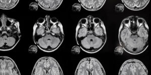 Images from a Brain MRI