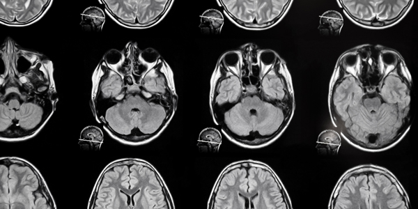 Images from a Brain MRI