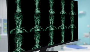 MRA Images of Brain on Monitor